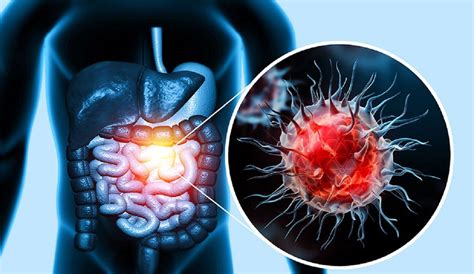 Cancer colorectal: cele mai consumate 2 alimente cancerigene.